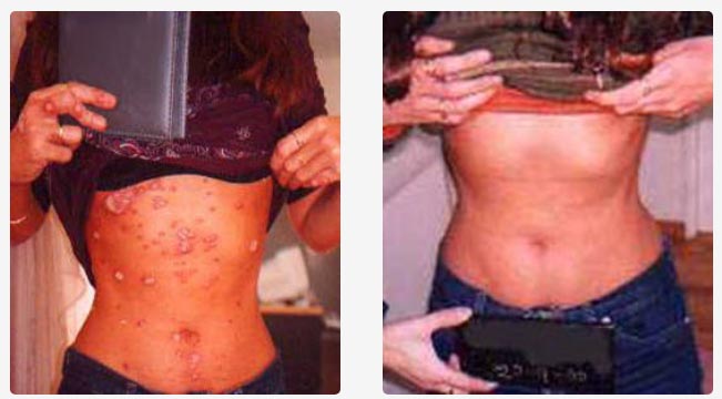 Tratamiento en codos