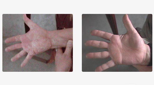 Psoriasis en placa espalda